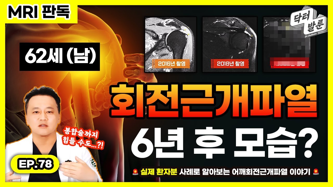 【환자사례】🚨6년동안 회전근개파열을 방치하면 어떻게 될까요?  62세(남) 환자분의 MRI로 알아보는 회전근개파열의 진행단계  #회전근개파열 #어깨통증   내가 알려줄게!ㅣ닥발TV