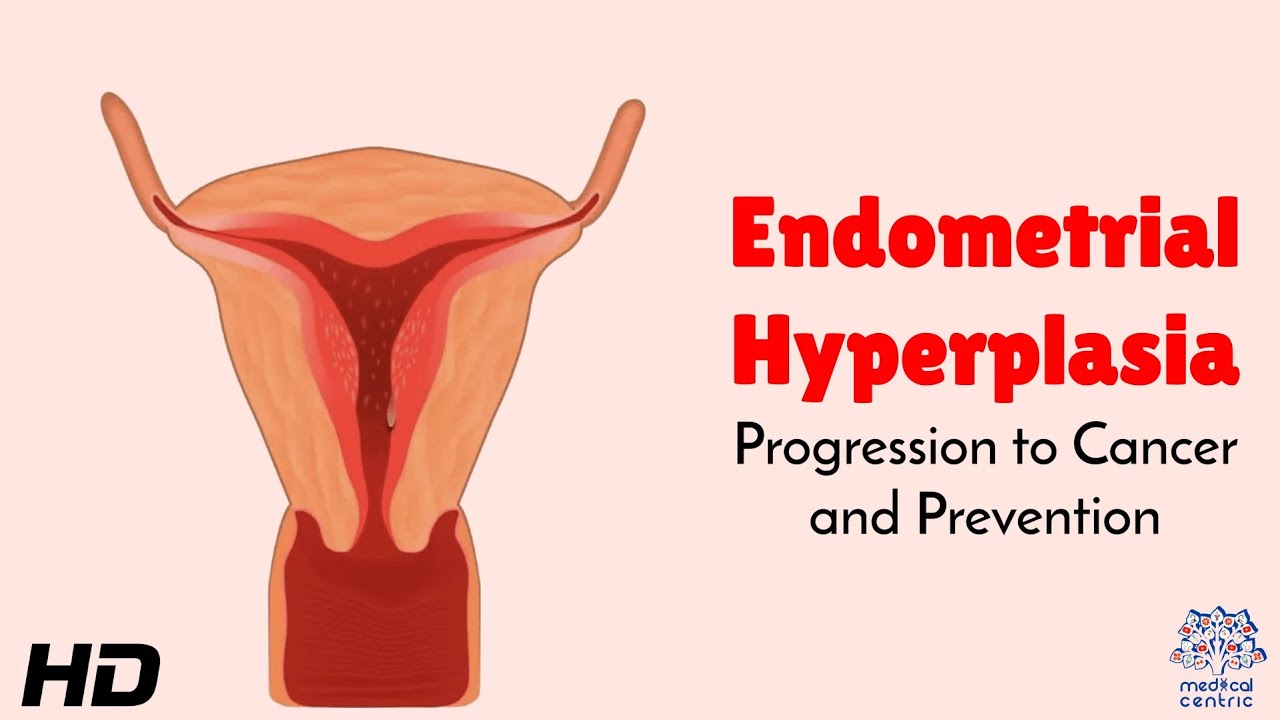 Endometrial Hyperplasia Progression to Cancer and Prevention: What Every Woman Should Know