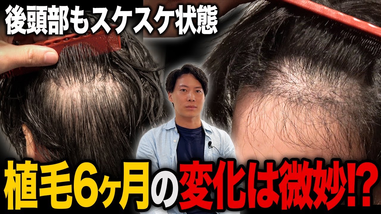 【悲劇】植毛から6ヶ月経過しても後頭部の透け感は治らない!?