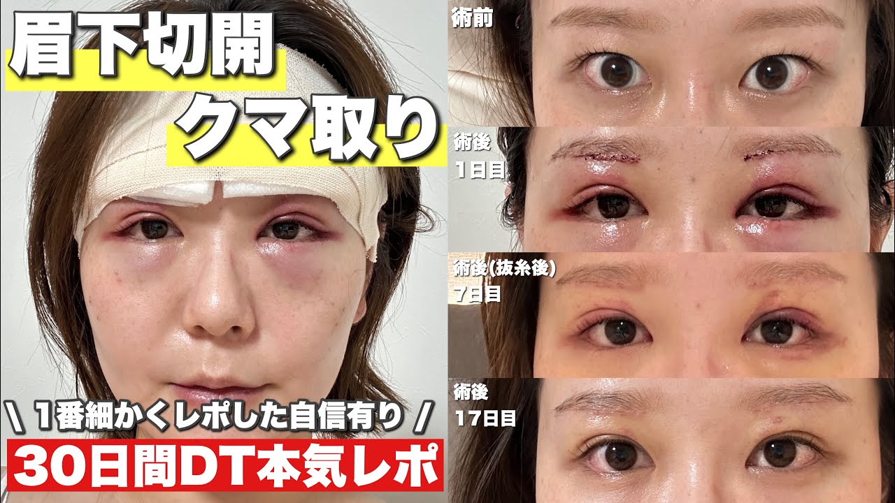 【美容整形】眉下切開とクマ取りDT30日間！誰よりも細かくレポ！~30代のアンチエイジング~同じ悩み抱えてる人向け🍀