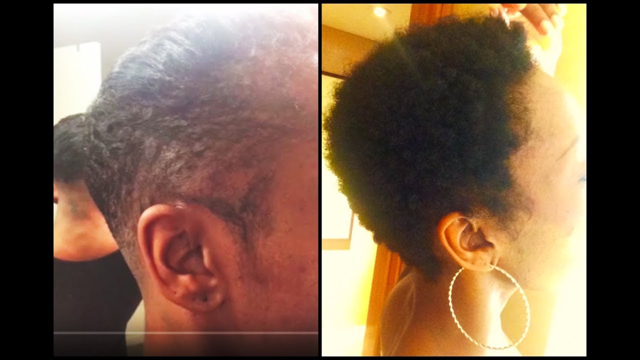 1 Year FUE Success Tamrell/African American
