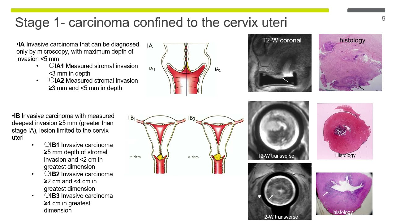 ISMRM MR Academy - Cervical Cancer