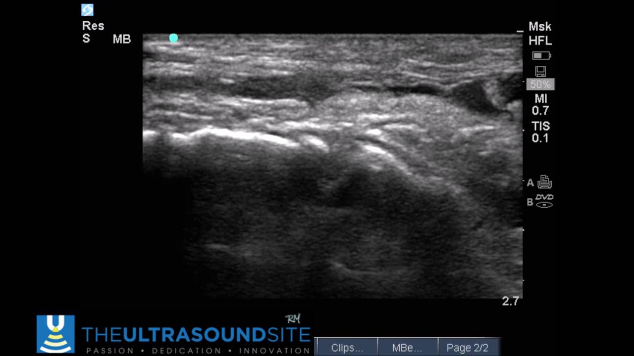 Tibialis Anterior Rupture II