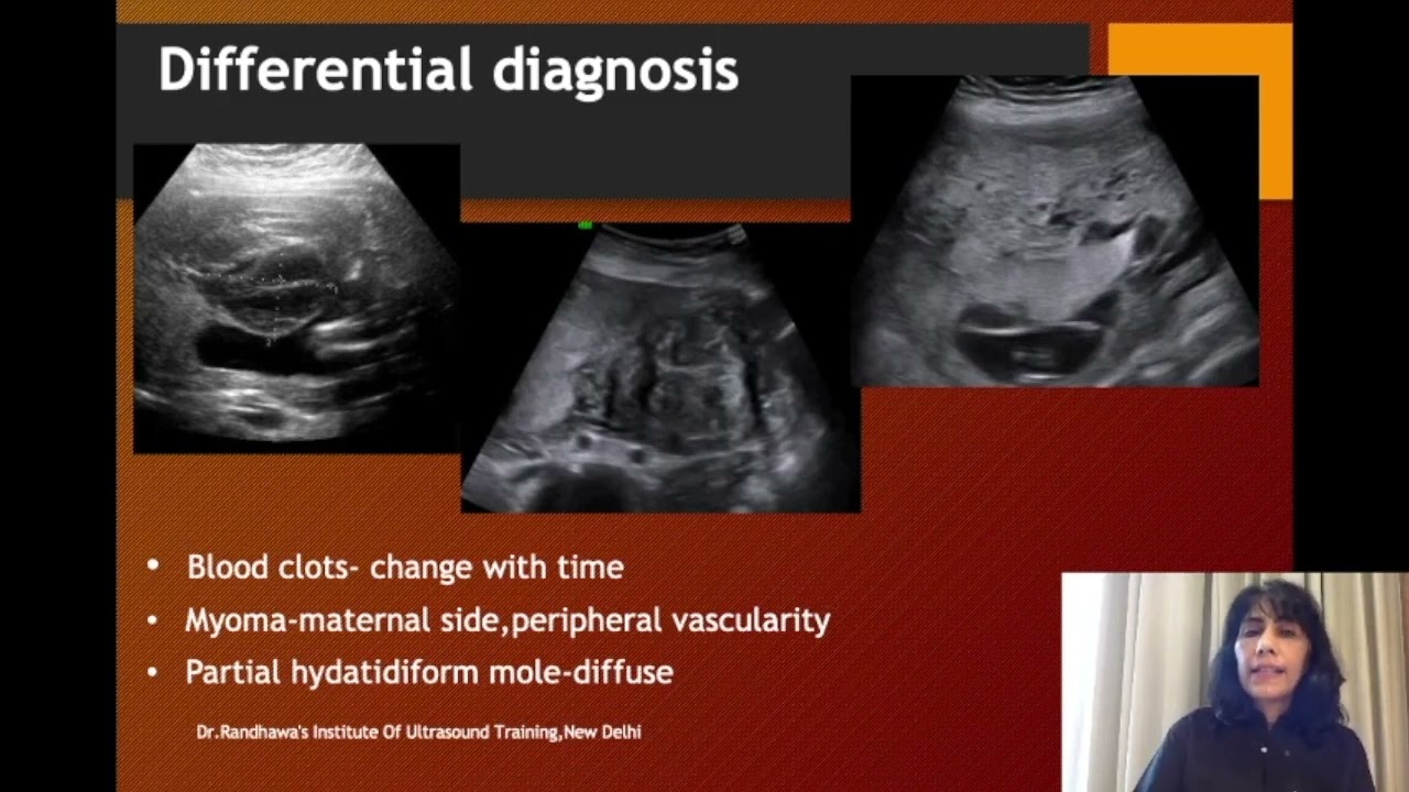 Ultrasound-Placenta -Chorioangioma