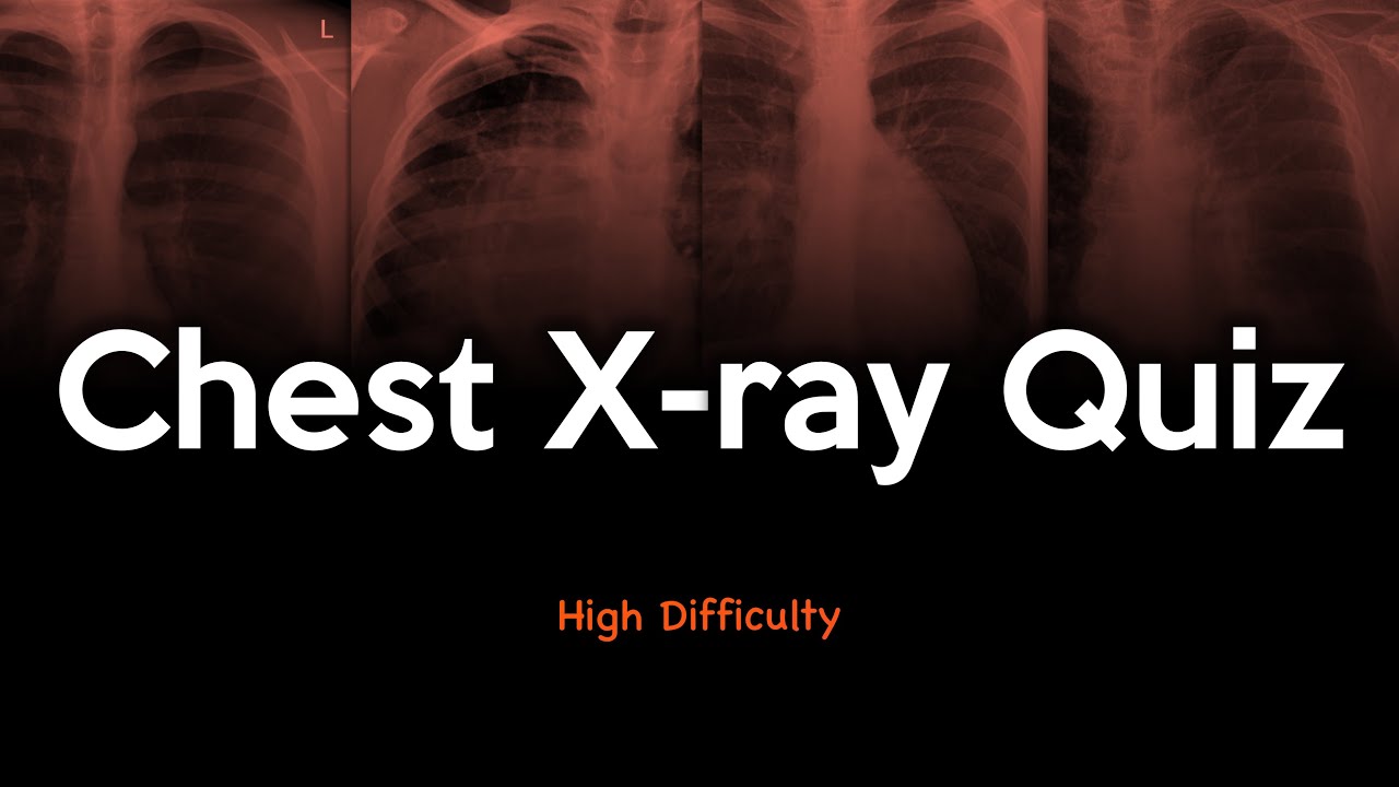 Chest X-ray Quiz: High Difficulty