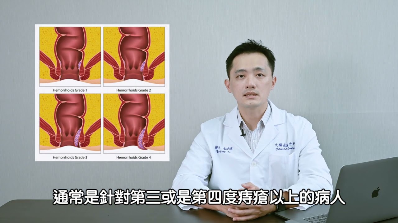 【盧延榕醫師】雷射痔瘡消融手術衛教影片｜Laser Hemorrhoidoplasty