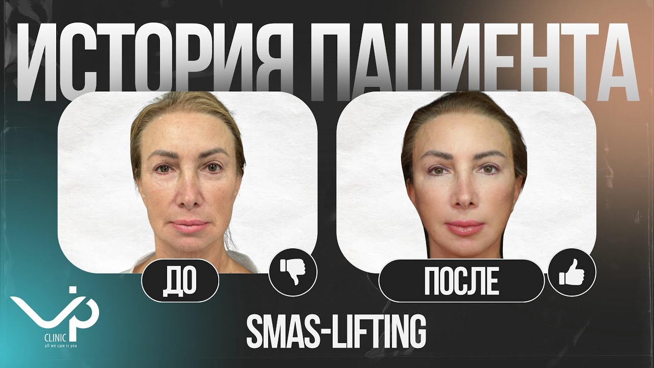 КООРДИНАЛЬНОЕ ПРЕОБРАЖЕНИЕ В 58 ЛЕТ | История пациента Vip Clinic