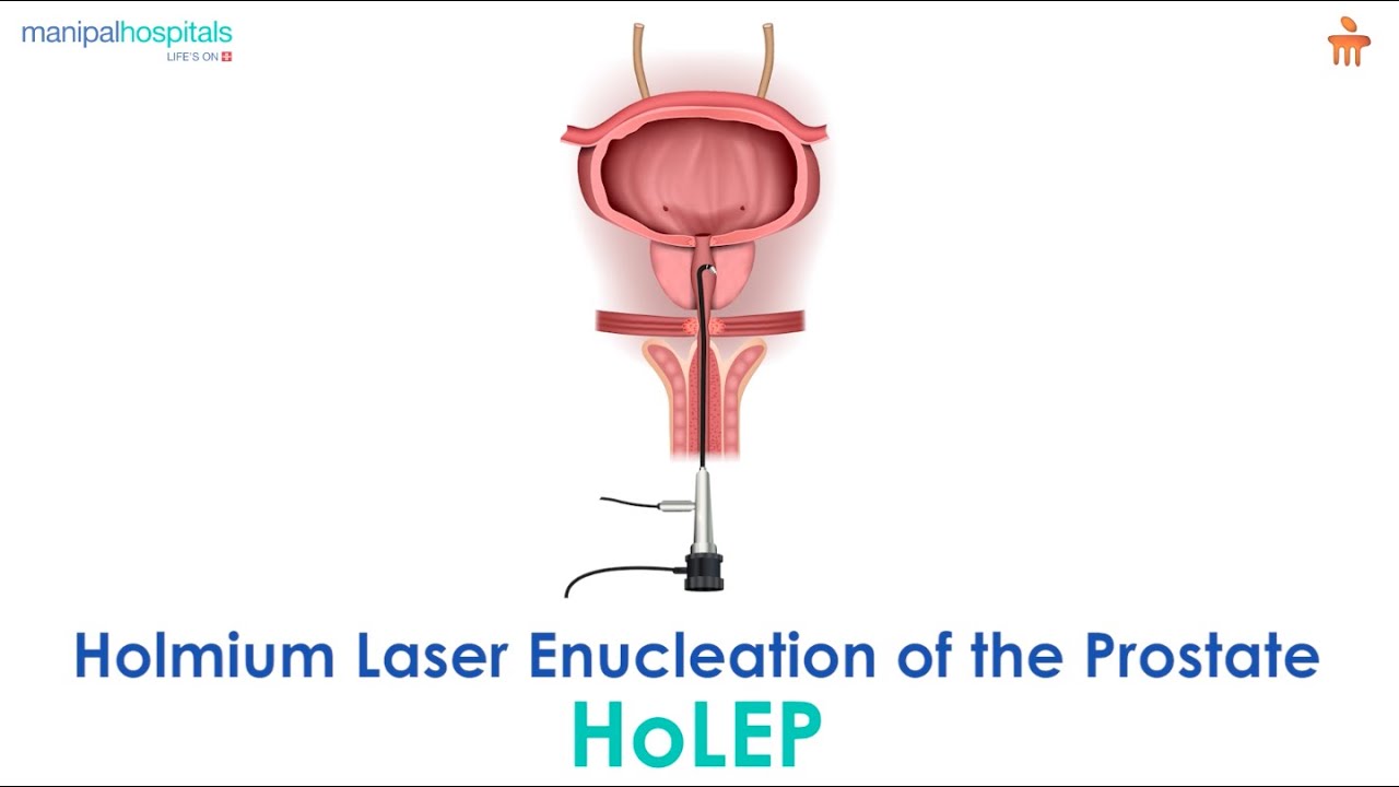 What is Holmium Laser Enucleation of the Prostate? l Manipal Hospitals Bengaluru