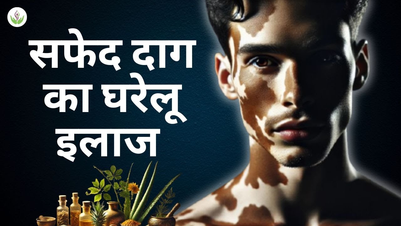 घर पर सफेद दाग का इलाज कैसे करें? | Treat Vitiligo at Home | Care Well Medical Centre