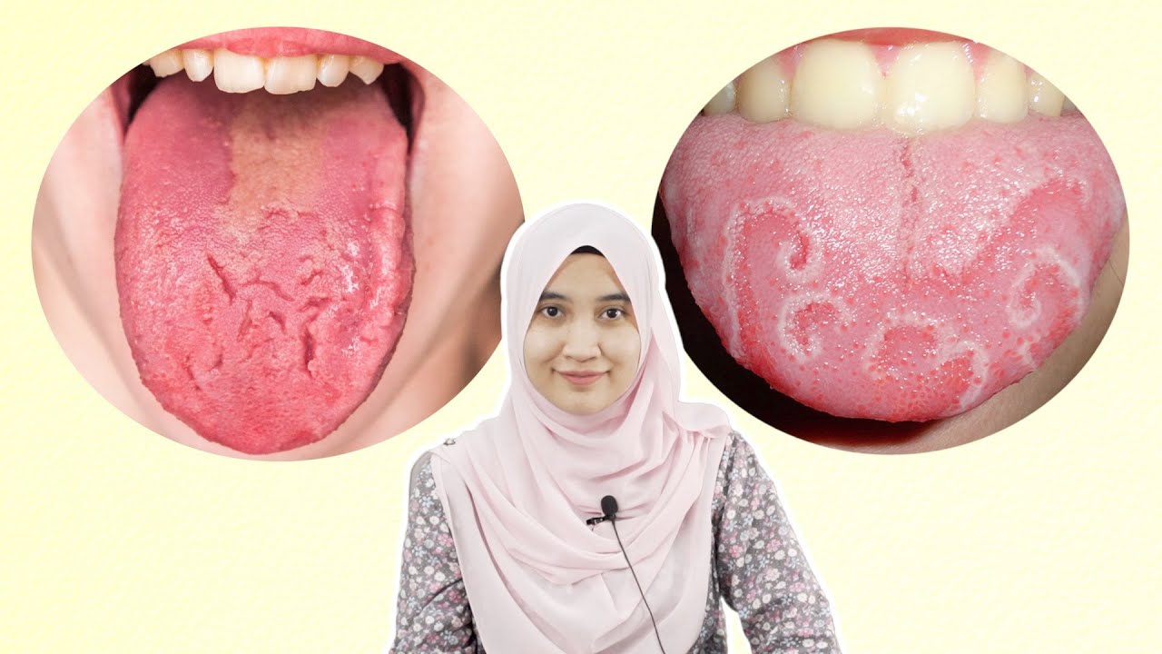 Kenapa Ada Lidah yang Nampak Macam Pecah?