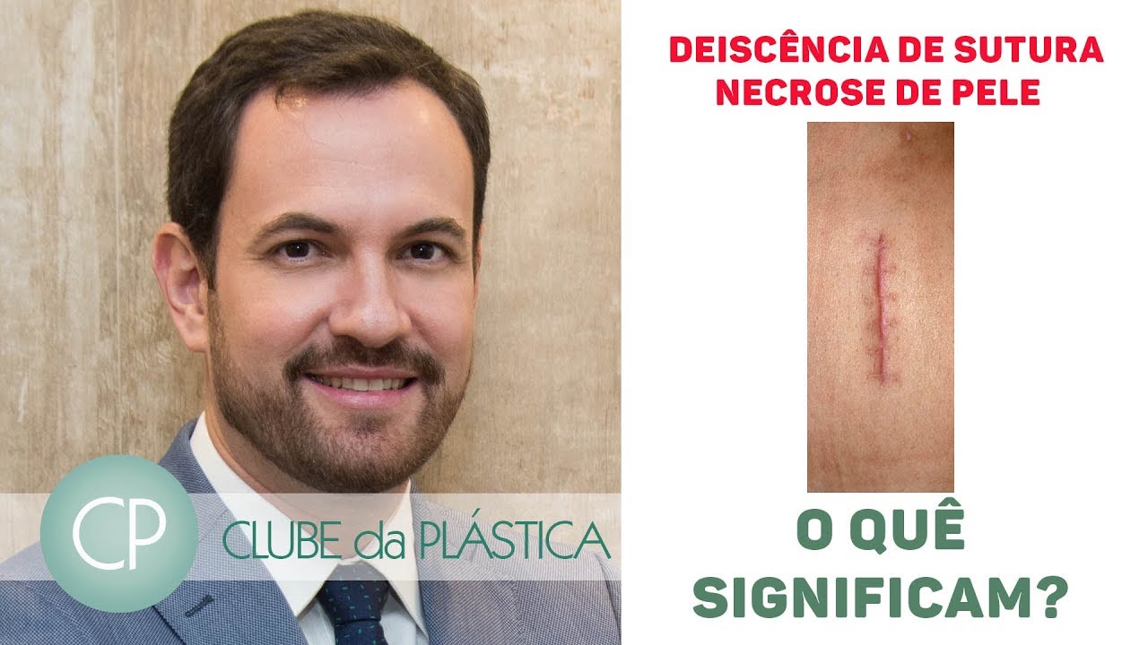 Clube da Plástica: deiscência de sutura e necrose de pele - o que significam?