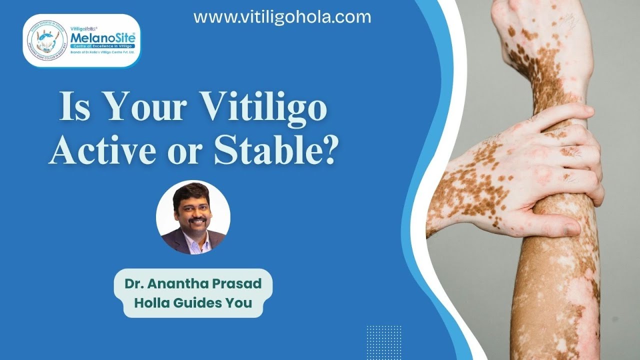 How to Know If Your Vitiligo Is Active or Stable | Dr. Anantha Prasad Holla Explains