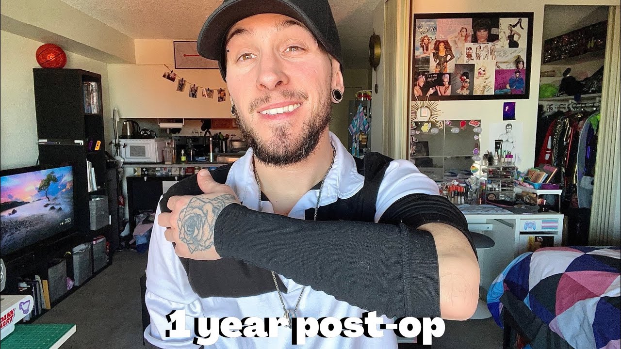 1 year post-op RFF Phalloplasty