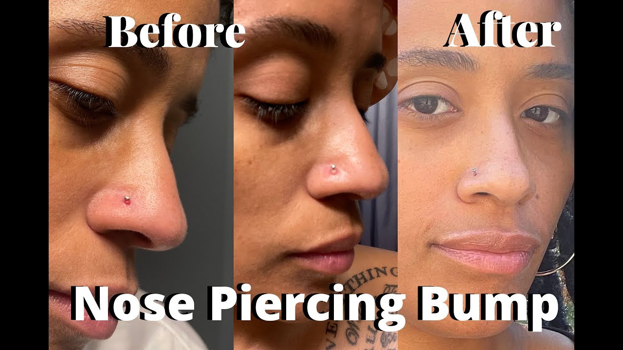 How to get rid of a nose piercing bump - My Journey