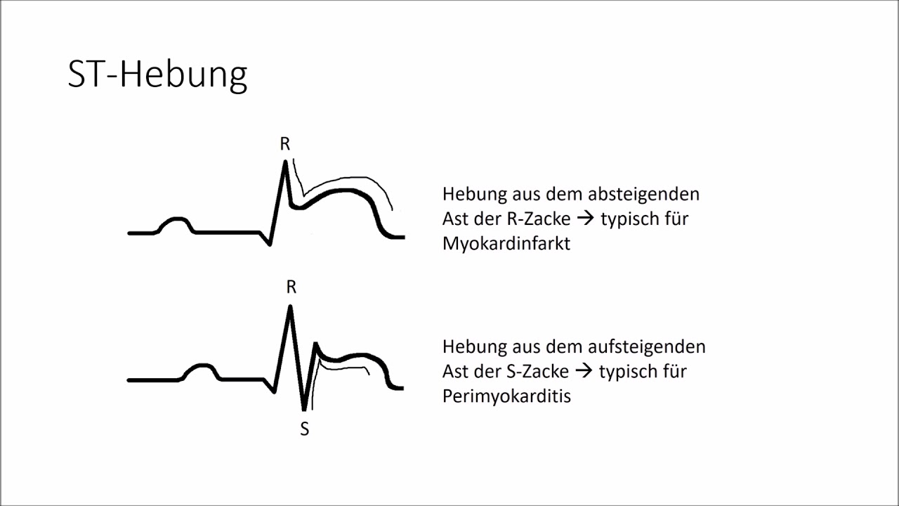 EKG verstehen; die Grundlagen (EKG Crashkurs Teil 1)