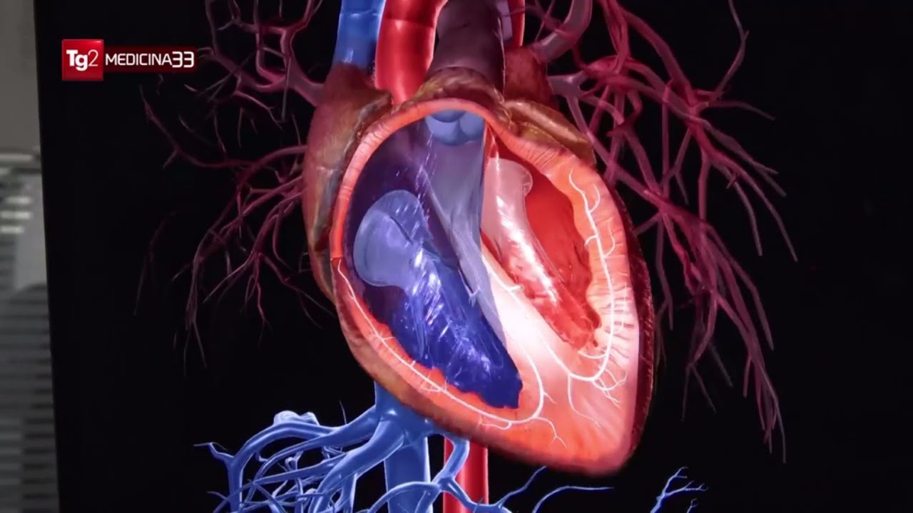 Fibrillazione atriale: la terapia con le radiazioni
