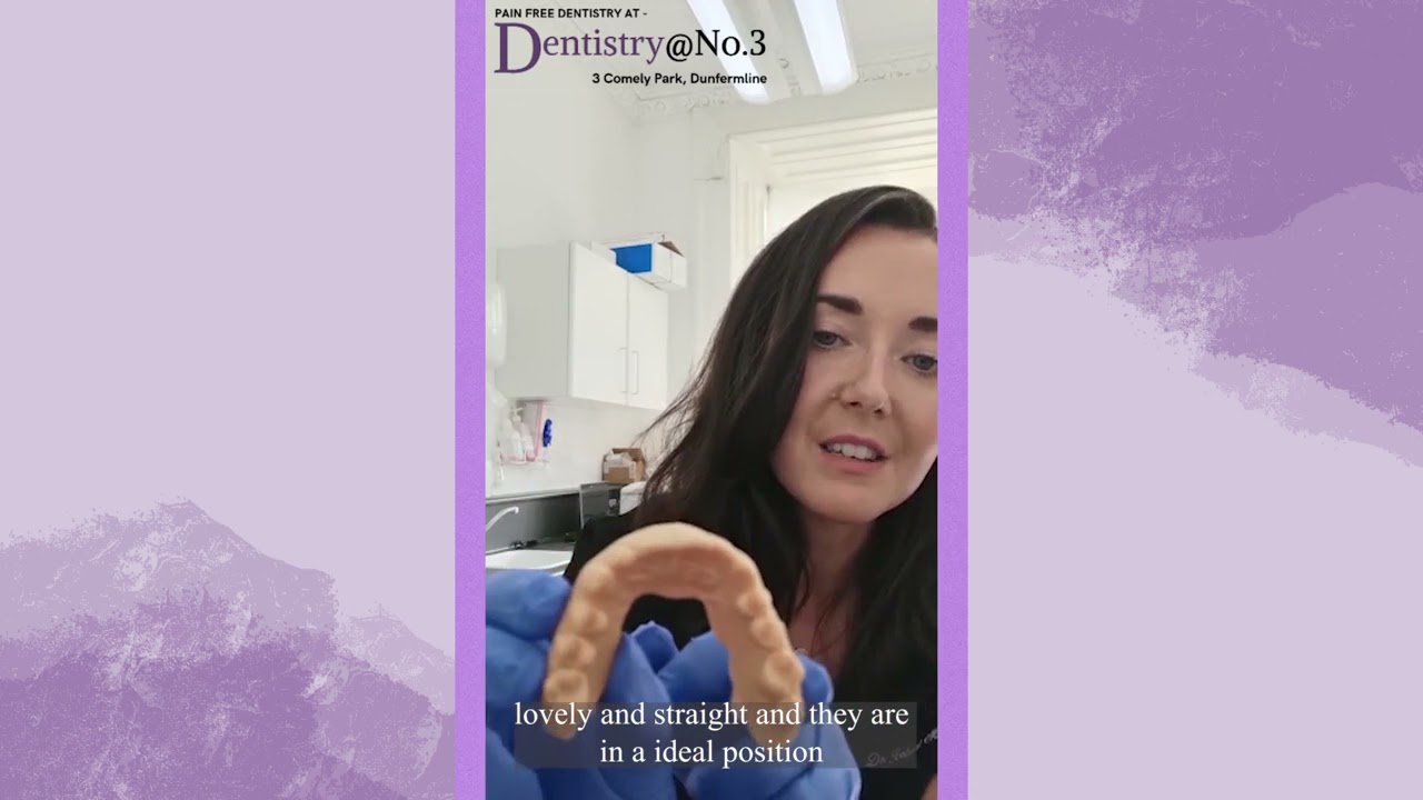 What Is The Planning Process For Porcelain Veneers?