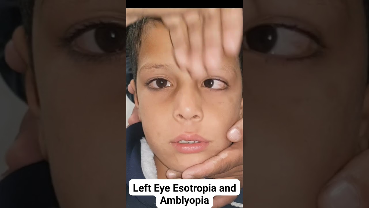 Left Eye Esotropia a manifested Squint and Amblyopia.#doctor #eyes #optometry #ophthalmology #squint