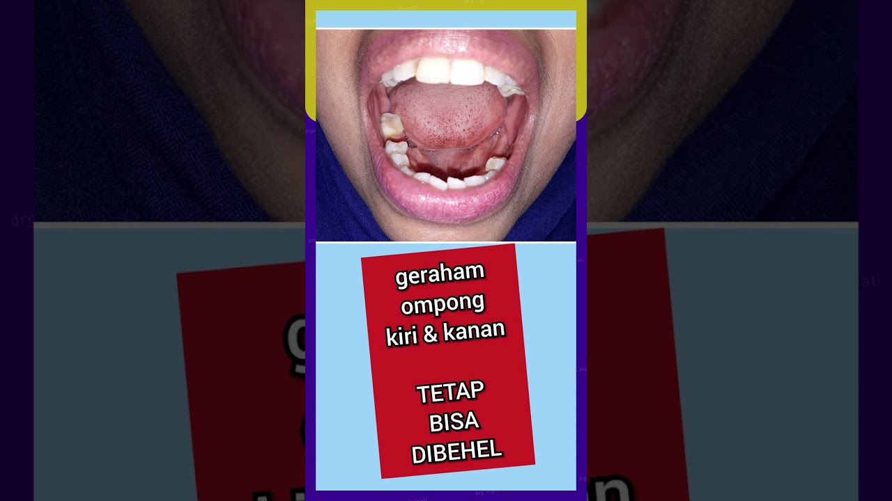 perawatan behel gigi tonggos geraham ompong dab bibir tebal