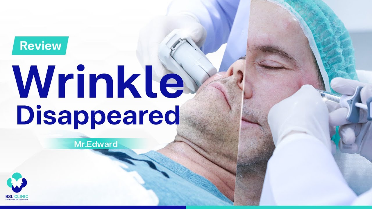 Filler Program | EP.3 | Smile Line & Wrinkle Reduction for a Youthful Look | BSL Clinic