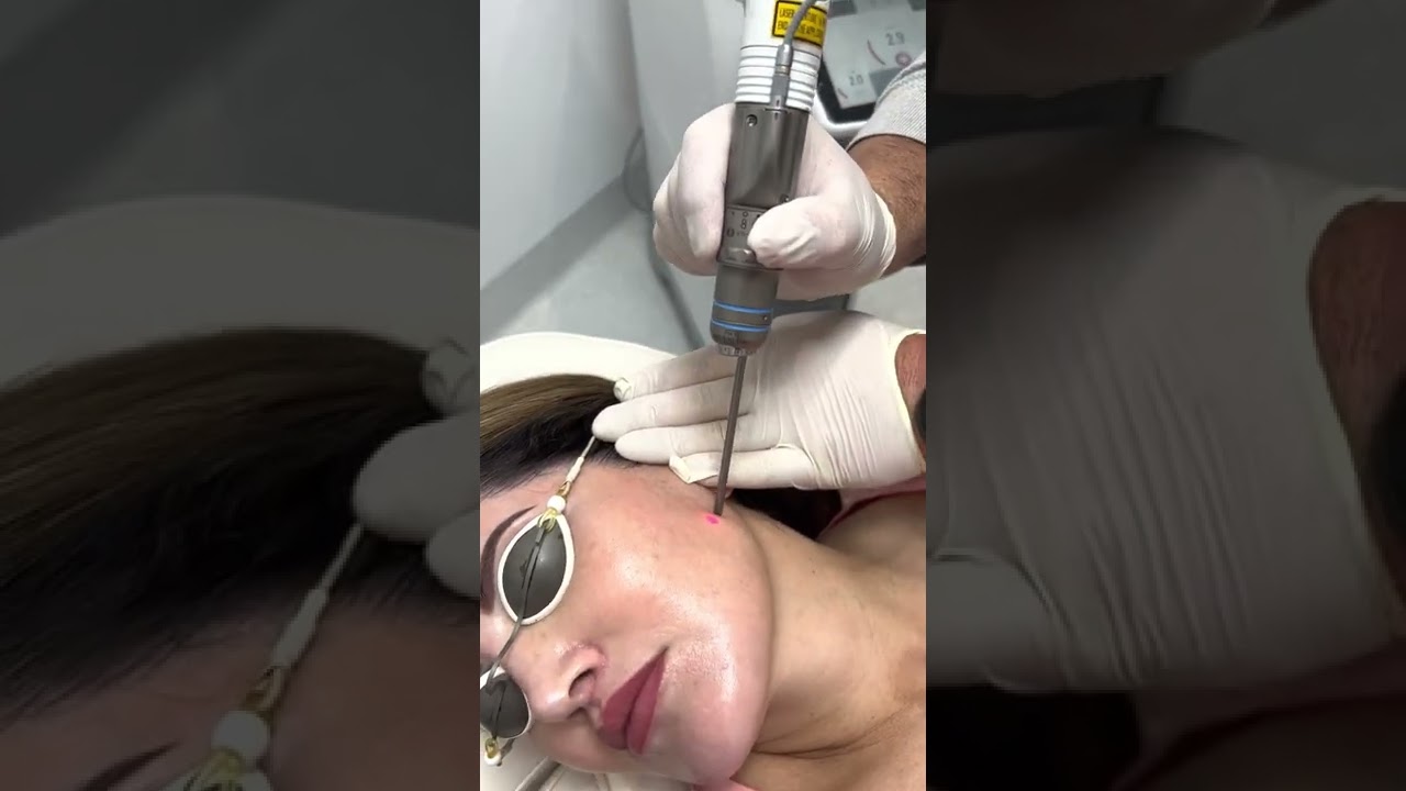 Pigmentation removal with Fotona  laser | Newcastle Cosmetic Doctor | Melasma laser treatment