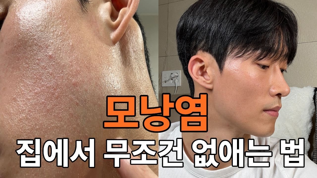피부과 안가고 집에서 모낭염 박살낸 방법 (여드름 VS 모낭염 구분법)