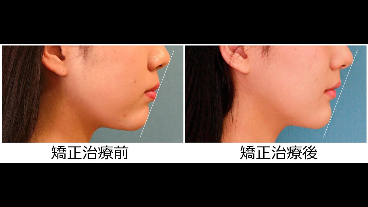 19歳 女性｛ 過去の矯正の 再治療 ｝「口もとを 下げたい」治療期間19か月