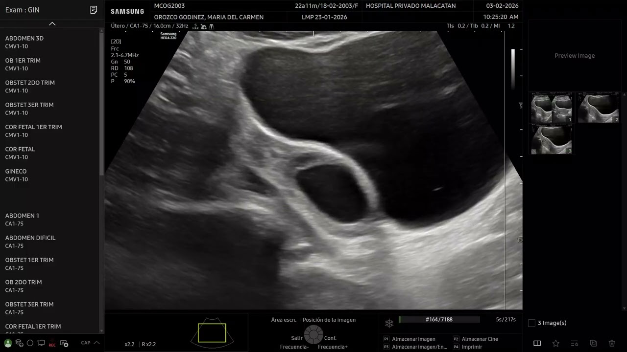 Training de manejo en el z20. Eco TV con uso del 3D Y 5D, IOTA, E-CERVIX, Y 2D FOLÍCULO. Malacatán.