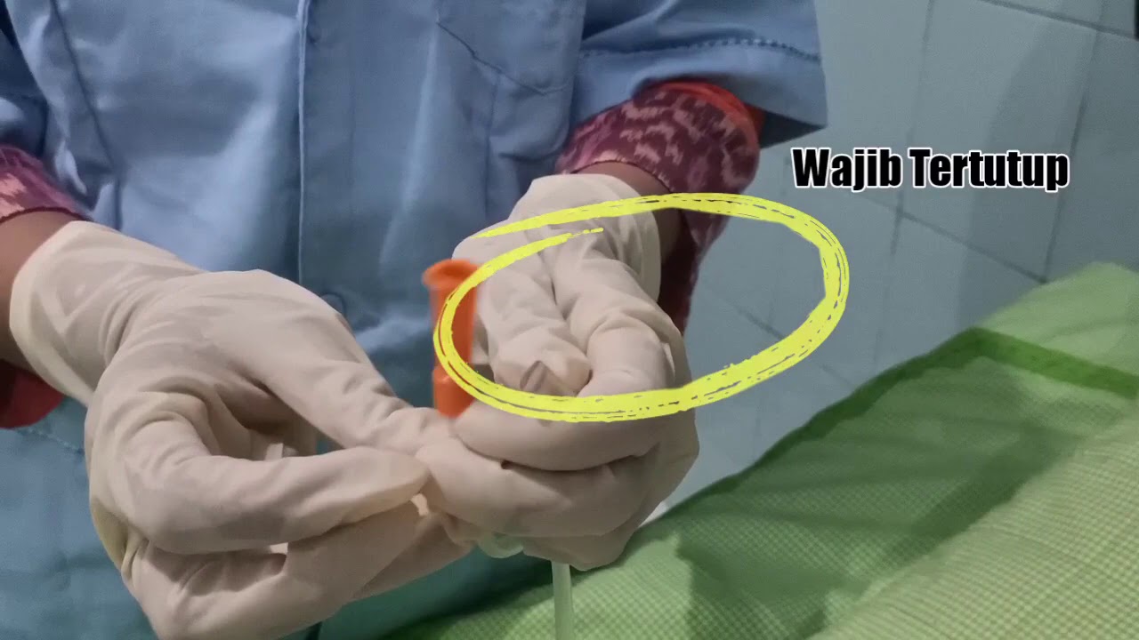 Prosedur Pemberian Nutrisi Melalui Selang Lambung (NGT/Nasogastric Tube)