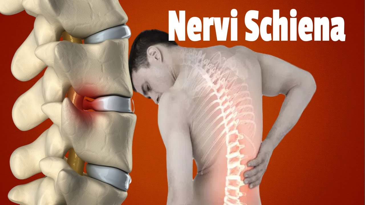★   Nervi Schiena, Dolore Gamba Sinistra Cause, Come Curare La Sciatalgia, Come Si Cura La Sciatica