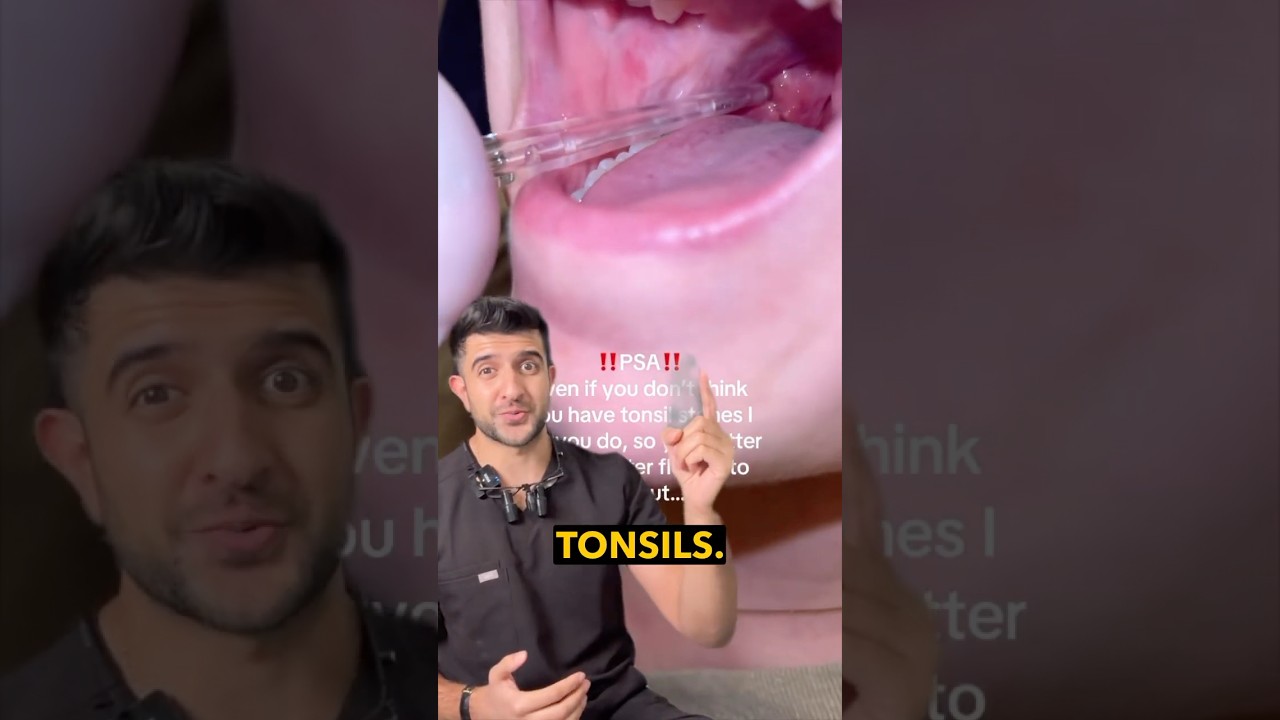 If You Have Tonsil Stones, WATCH THIS! 😮🦷