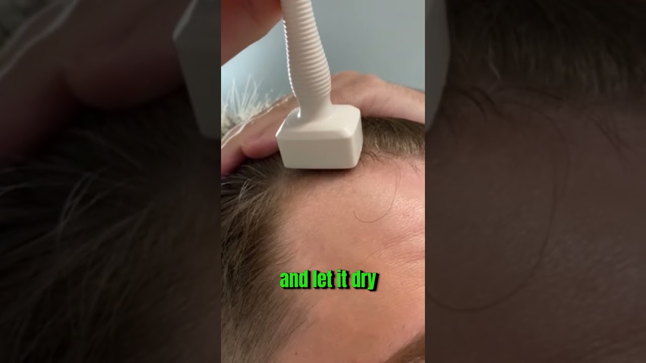 This Is How I Use My Derma Stamp To Increase My Hair Growth