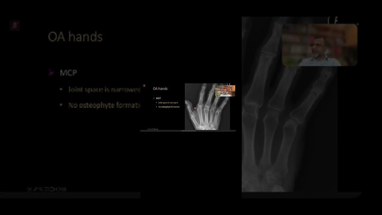 Arthritis Radiology DKT Viva Made Easy FRCR  (CPPD, Gout and RA)