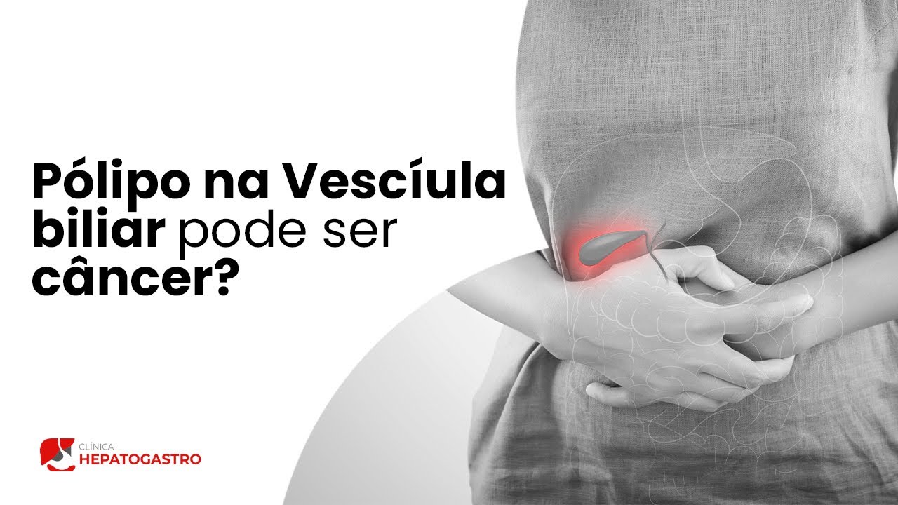 Pólipo na Vesícula Biliar pode ser câncer? | Clínica Hepatogastro