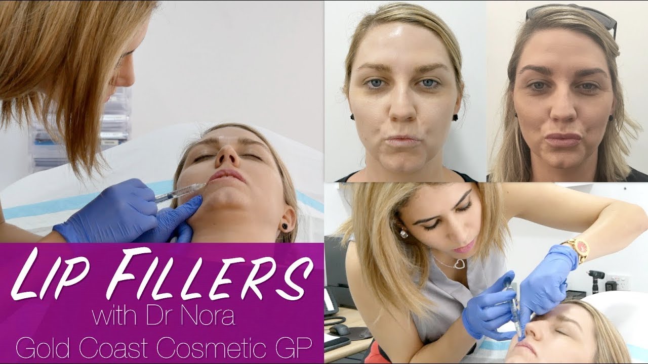 Lip Fillers in Gold Coast | From a Thin Upper Lip to Plump Natural Looking Lips