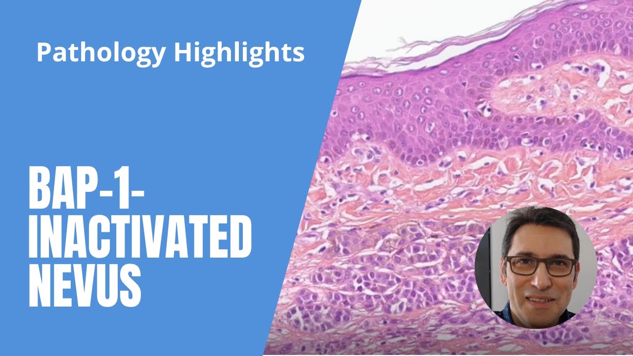 Pathology Highlights : BAP1-inactivated nevus (typical case with link to virtual slide)