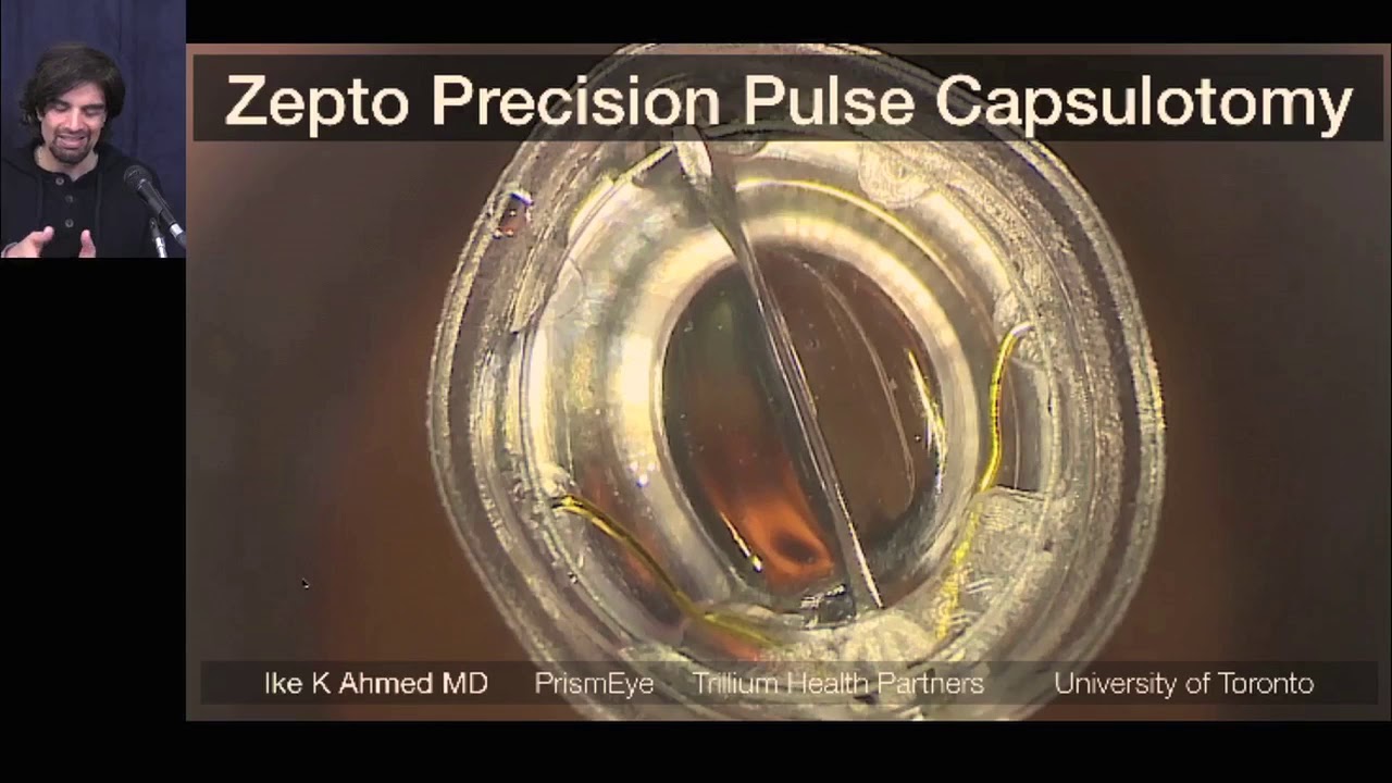 Session 1: Dr. Ike Ahmed ZEPTO&reg;️ Webinar &ndash; Introduction to ZEPTO&reg;️ Capsulotomy