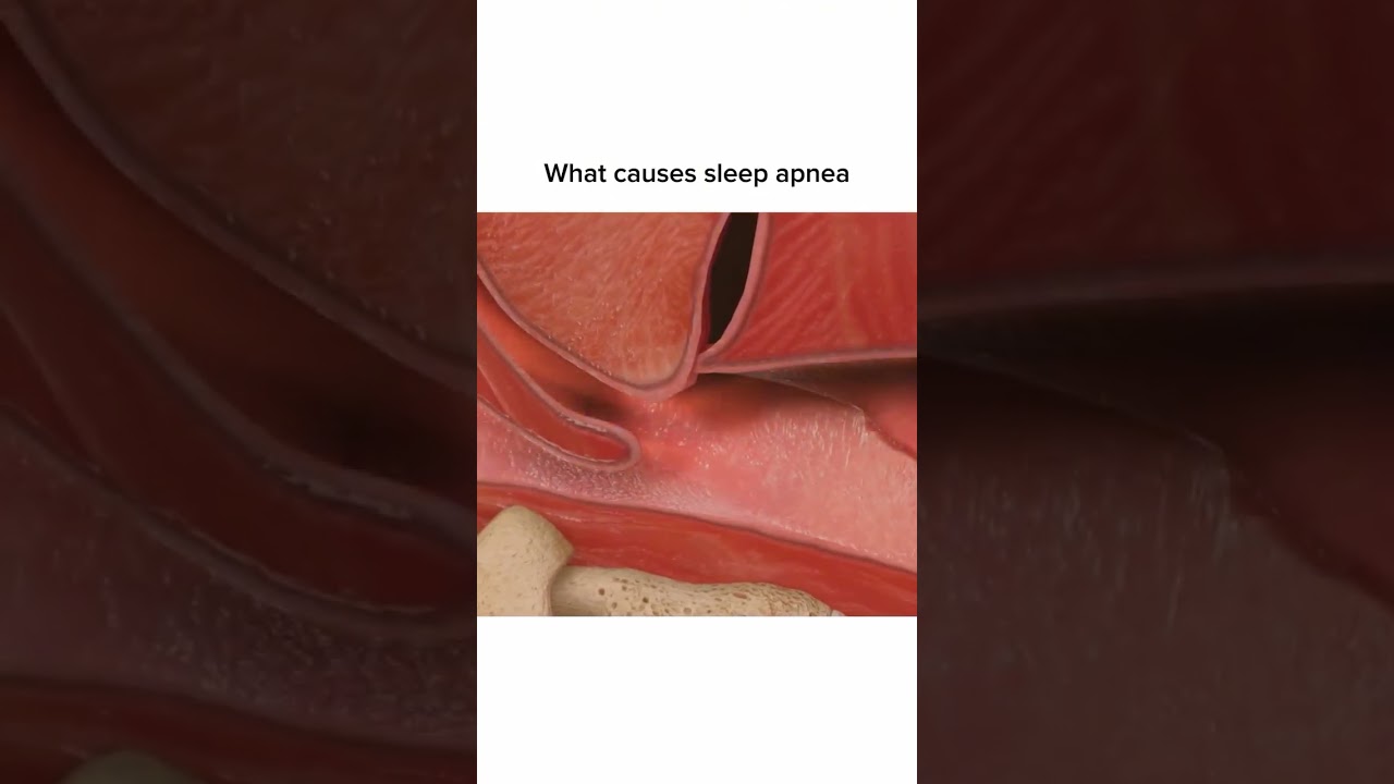 Sleep Apnea Animation #medicalstudent #anatomy #animation