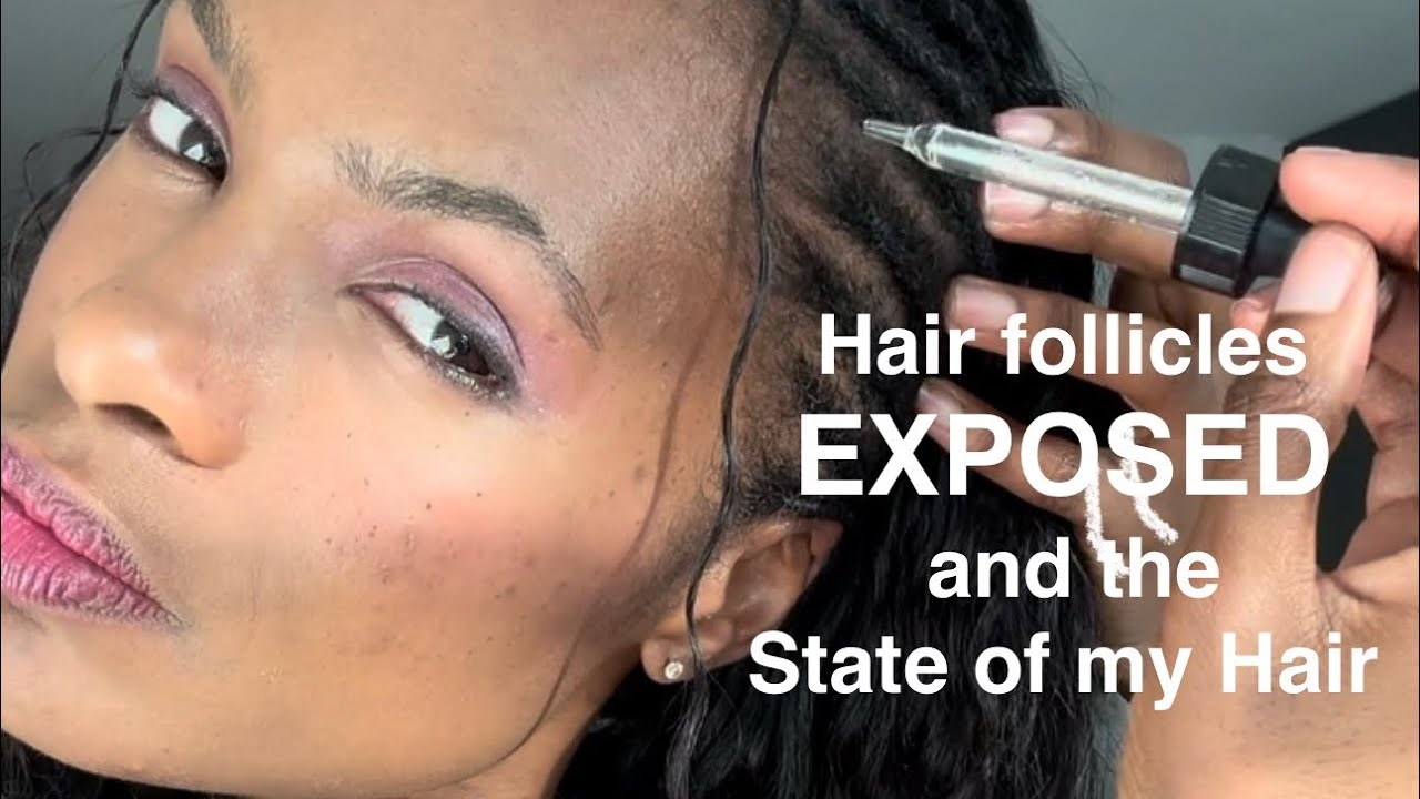 Hair follicles coming up from the ROOT? the current state of my hair… 😥#hairoil + #scalpmassage 