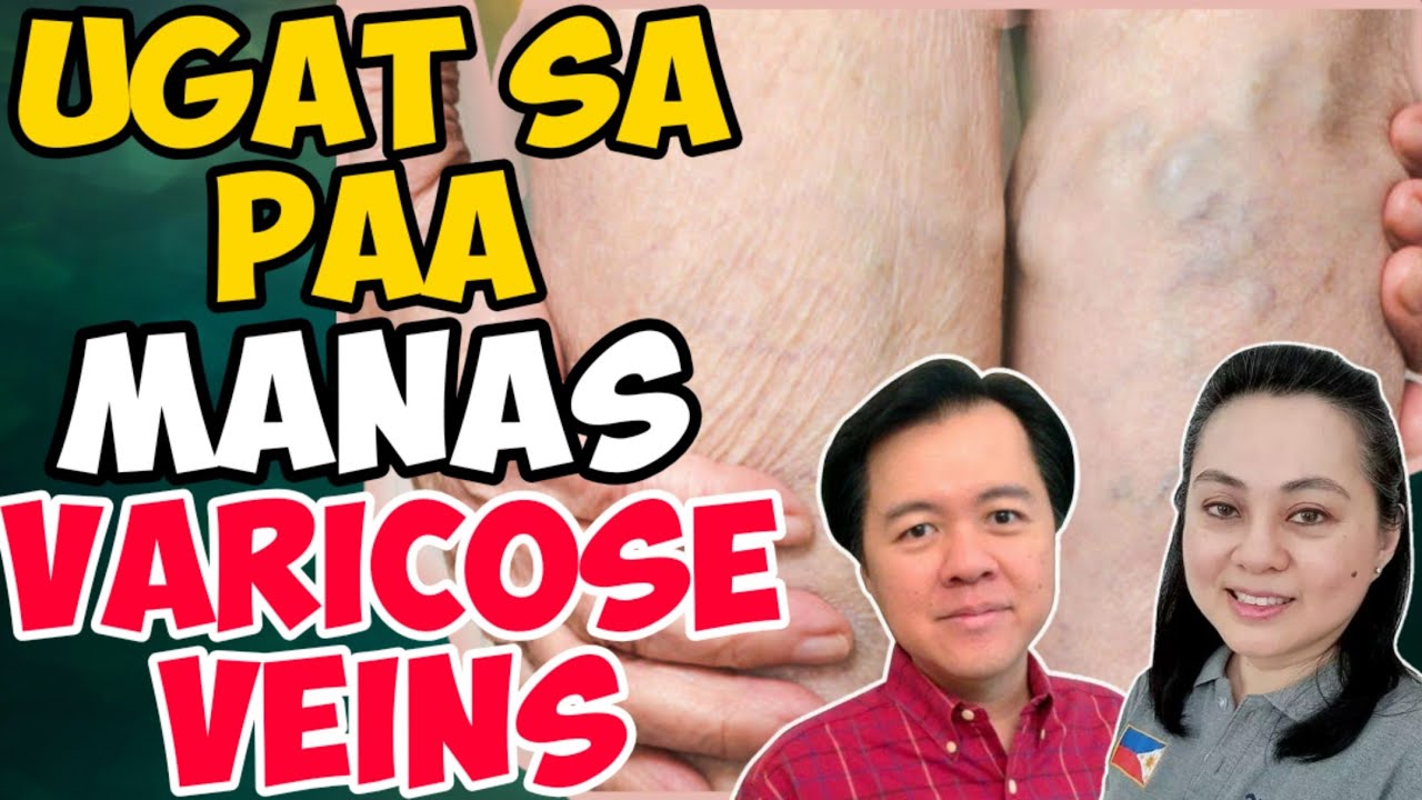 UGAT sa PAA: Manas, Varicose Veins - ni Doc Willie at Liza Ong #263b