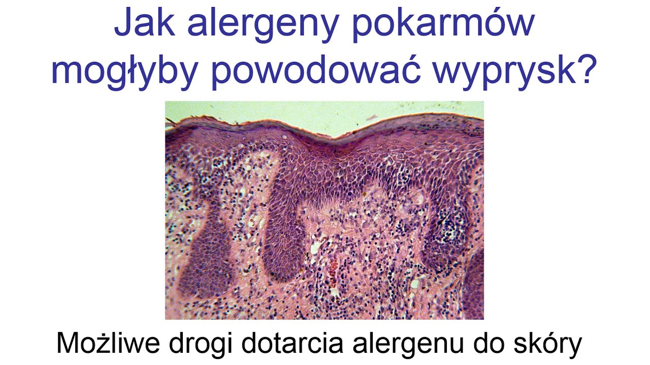 Atopowe zapalenie skóry a alergiczny wyprysk kontaktowy: Rola alergii pokarmowej
