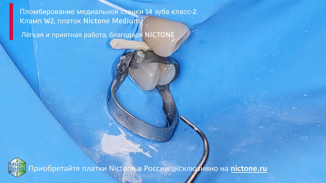 Фиксация матрицы на медиальной поверхности зуба 14 клампом W2 4K
