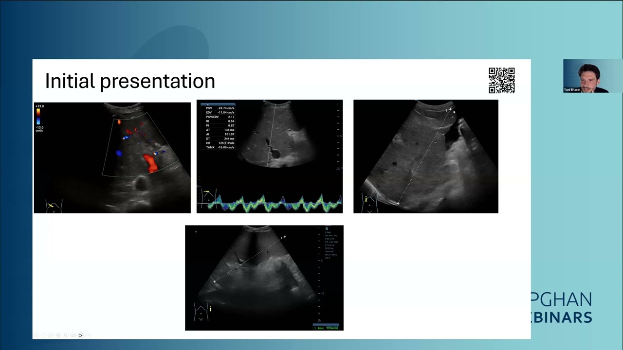 ESPGHAN Webinar - Portal hypertension SIG: clinical cases and update on current literature
