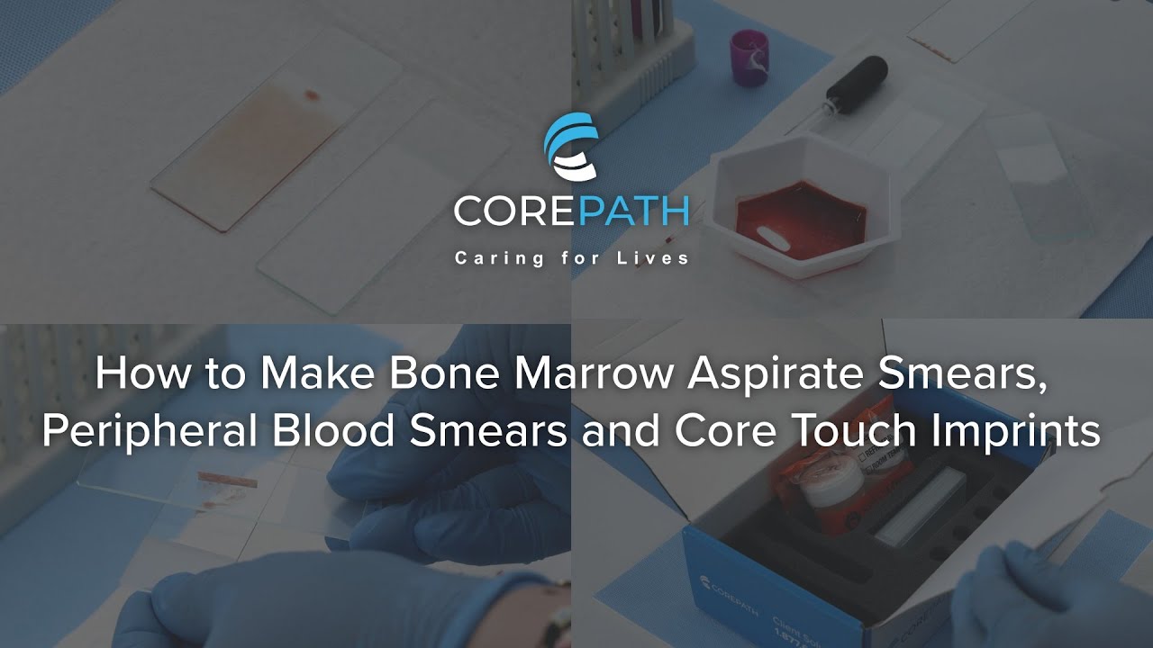 How to Make Bone Marrow Aspirate Smears, Peripheral Blood Smears and Core Touch Imprints