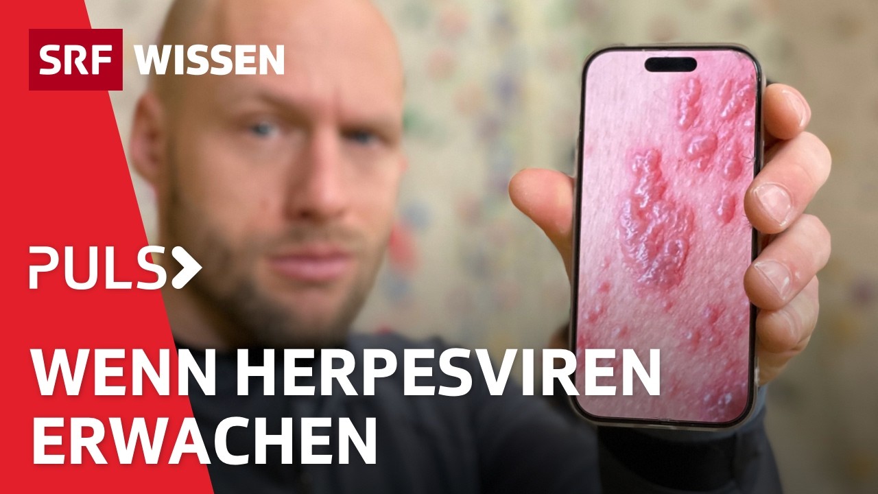 Gürtelrose, Fieberbläschen: Herpesviren stoppen, bevor sie gefährlich werden | Puls | SRF Wissen