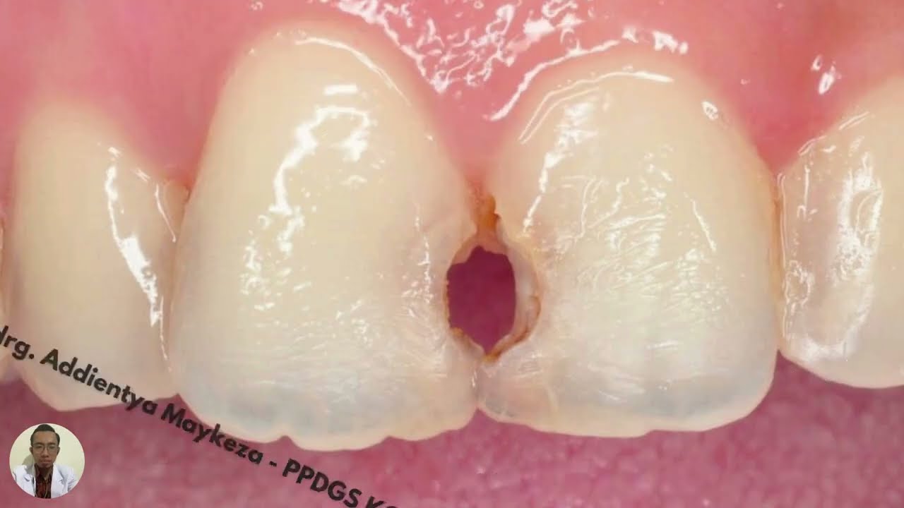 Video pembelajaran Restorasi kelas 3