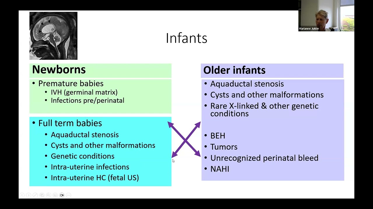 EANS Webinar: Fit for the shift – What you need to know about Hydrocephalus