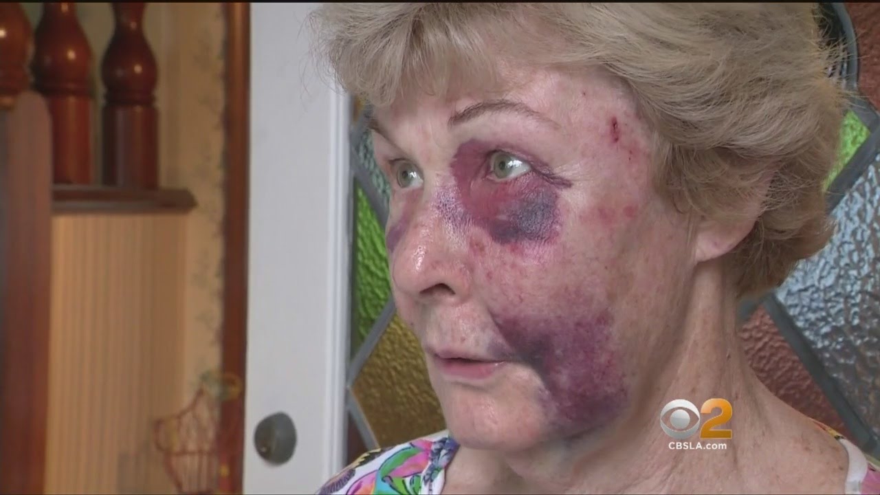 Torrance Woman Recounts Terrifying Ordeal During Home Invasion