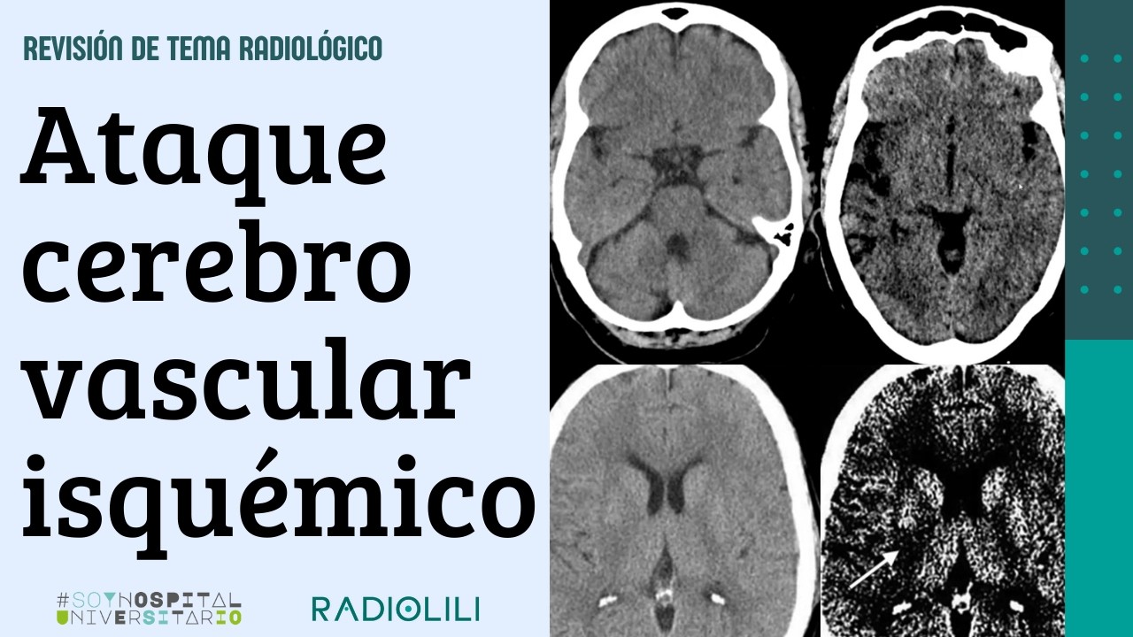 Ataque cerebrovascular isquémico