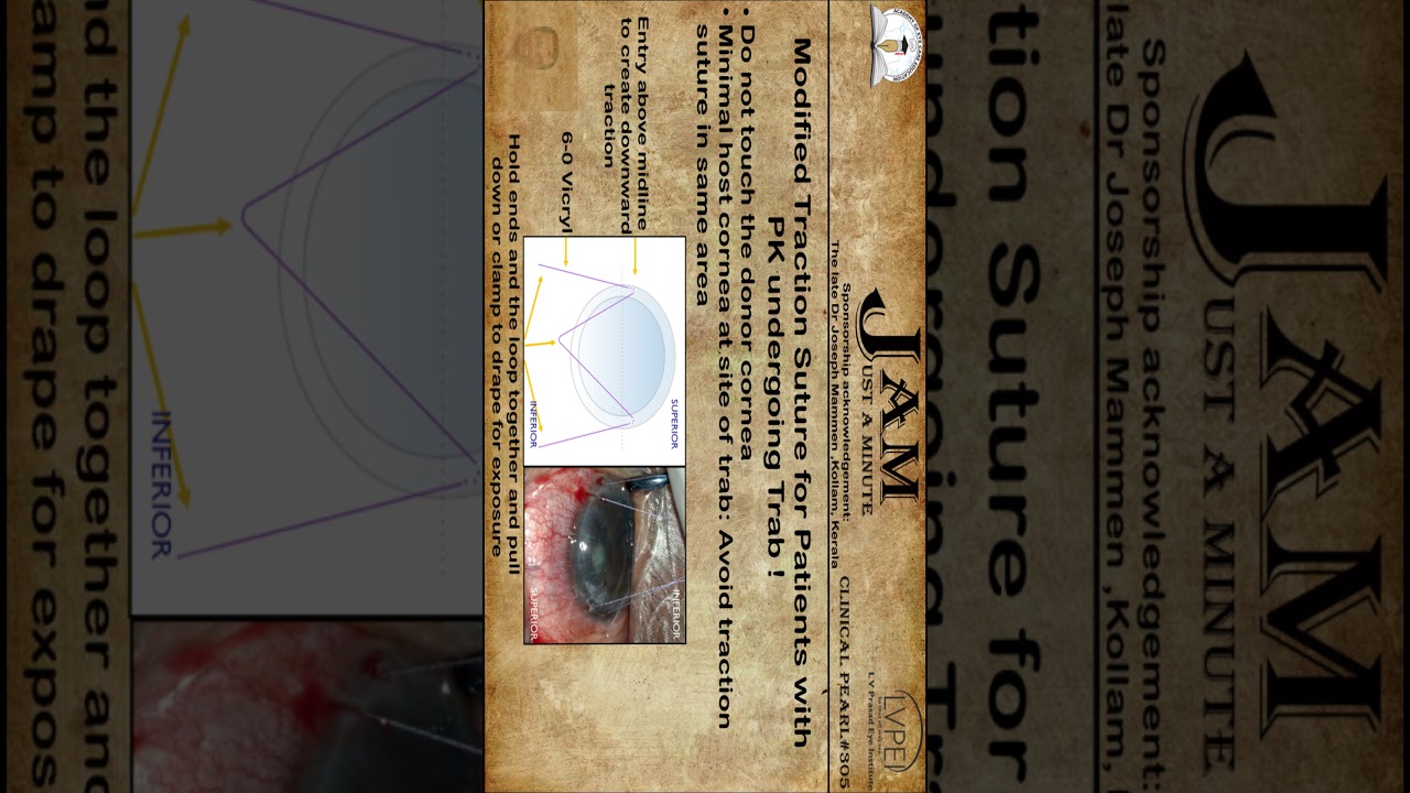 Modified Traction Suture for Patients with PK undergoing Trab!